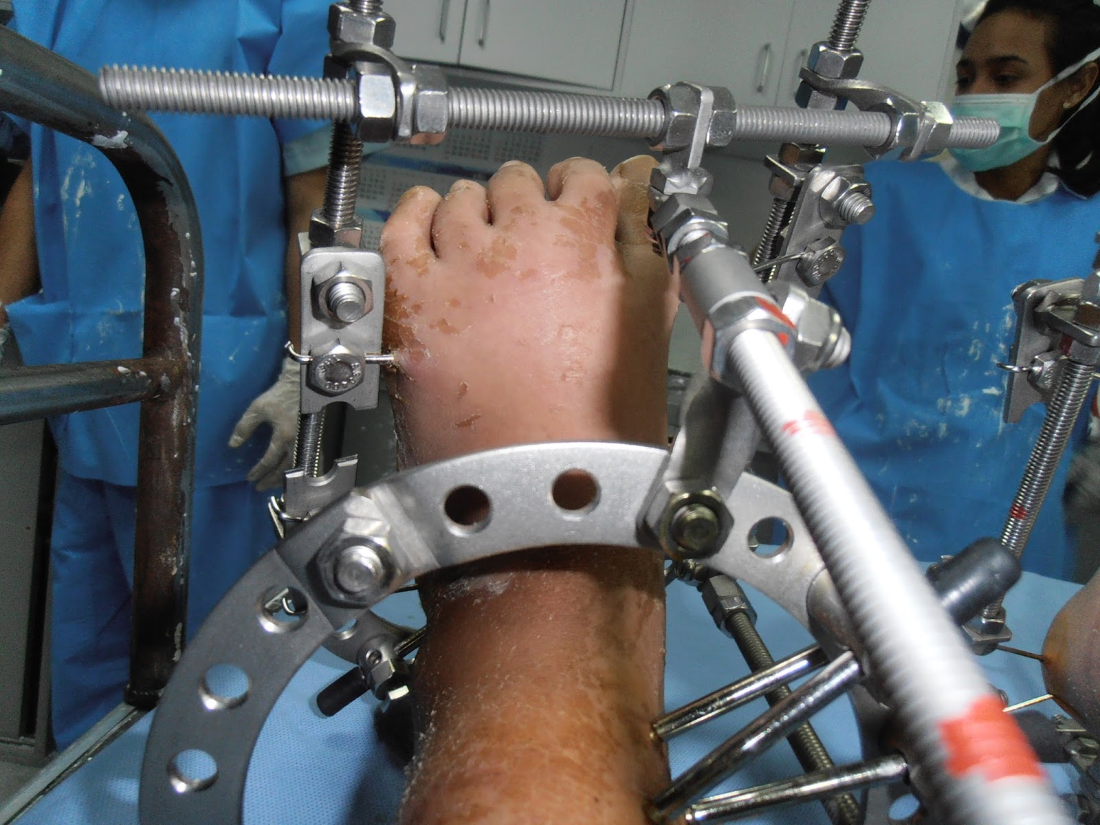 Caso clínico N° 7 Pie equinovaro congenito abandonado