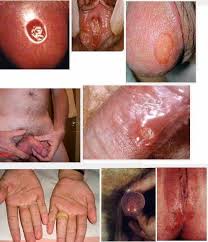 Sipilis