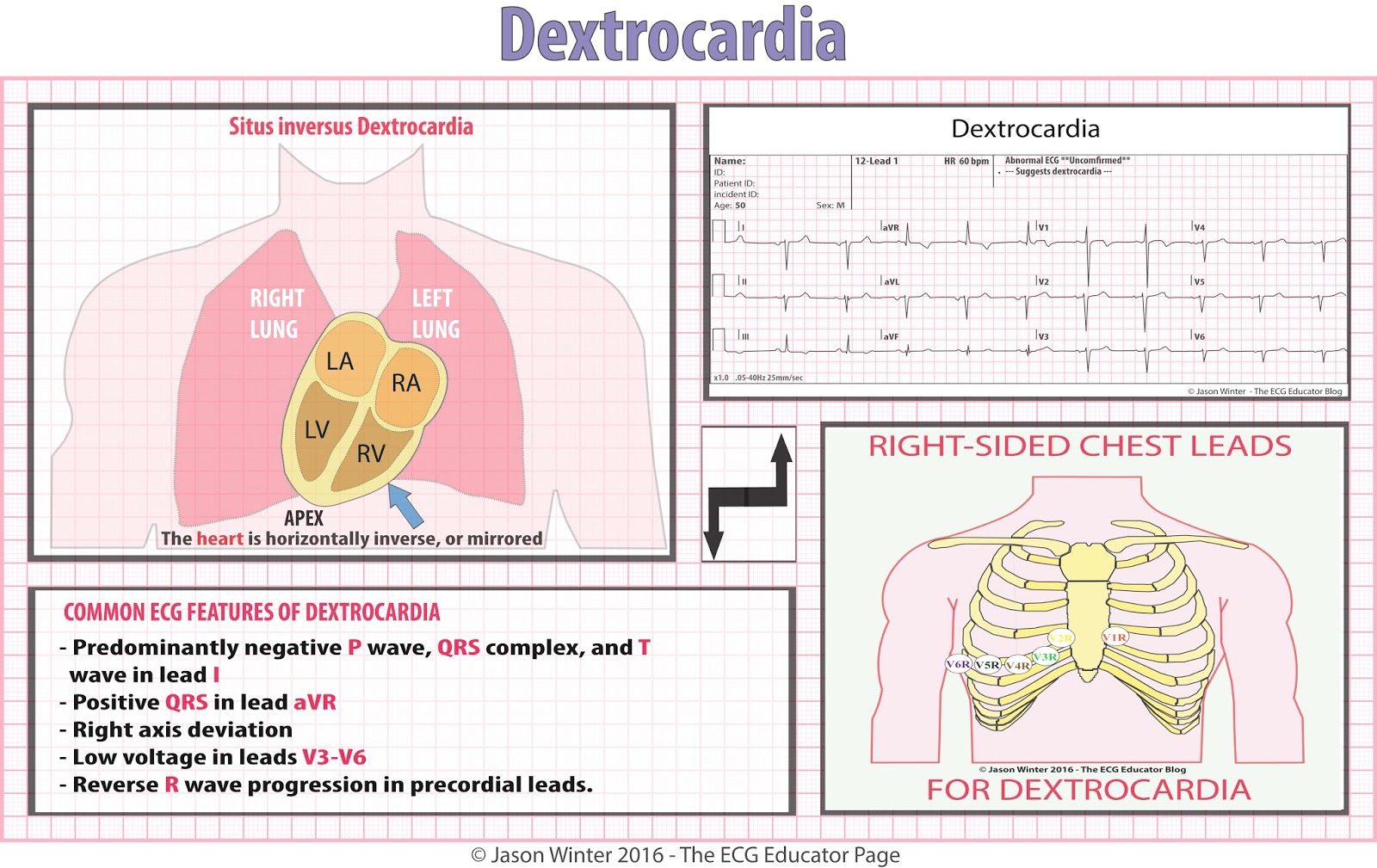 ECG Educator Blog Dextrocardia