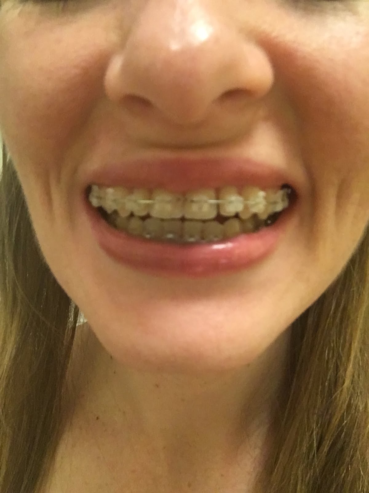 Alison's Jaw Surgery Blog Braces Progress
