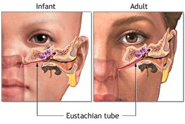 Blocked Eustachian Tube Can Lead To Acute Ear Infection