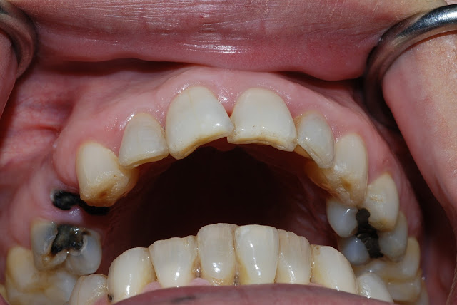 Những dấu hiệu của bệnh sâu răng Những dấu hiệu của bệnh sâu răng