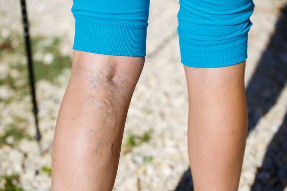 Cara Menghilangkan Varises Dengan Es Batu Hii Doc Cara Menghilangkan Varises Dengan Es Batu Hii Doc