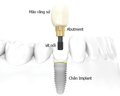 RĂNG IMPLANT BỊ LUNG LAY, KHẮC PHỤC RĂNG IMPLANT BỊ LUNG LAY