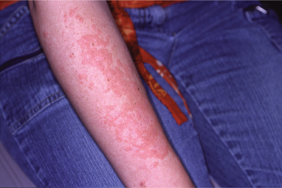 احذري بشرتك والحساسية الضوئية