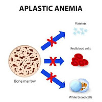 Anemia aplastik / AA (hematologi) Anemia aplastik / AA (hematologi)