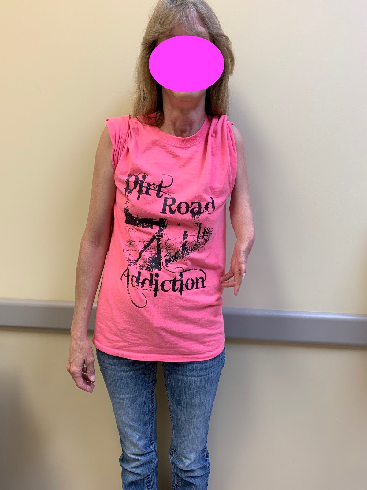 Short arm and hand deficiency or longitudinal deficiency