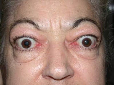 exoftalmos , hipertiroidismo, tiroides, malfunción exoftalmos , hipertiroidismo, tiroides, malfunción