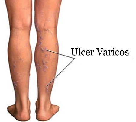 Complicaţii asociate varicelor: Ce trebuie să ştii despre ulcerul varicos