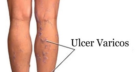 tratamentul vitaminelor varicoase