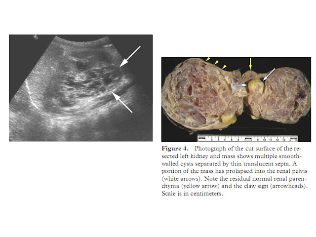BÀI SOẠN VỀ SIÊU ÂM CHẨN ĐOÁN: NHÂN CA MULTILOCULAR CYSTIC RCC tại MEDIC