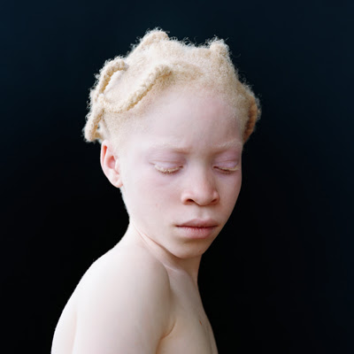 Albinizm: Rick Guidotti