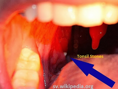 tonsil stones