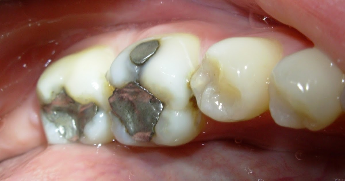 Barbielippman El Peligro en Tus Dientes Amalgama de Mercurio