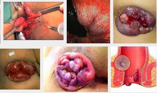 wasir ambeien hemorrhoida ambeyen hemoroid