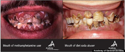 Dentist Proves: Diet Soda Can Cause Tooth Decay Like Cocaine