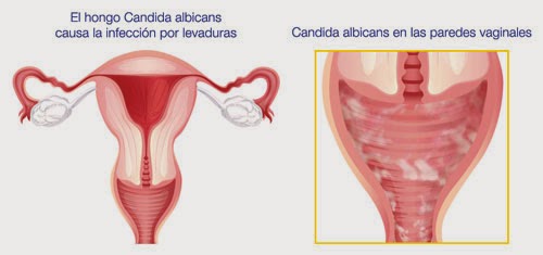 ¿Qué mata la infección por cándida en la piel? ¿Qué mata la infección por cándida en la piel?