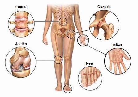 medicinski standardi za liječenje artroze)