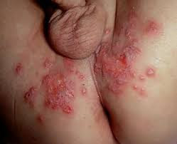Cara Mengobati Penyakit Herpes Yang Di Anjurkan Cara Mengobati Penyakit Herpes Yang Di Anjurkan