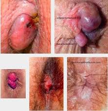 Foto Jual Obat Untuk Benjolan Nyeri Wasir dan Gatal di Sekitar Anus