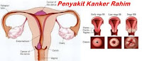 Kanker Rahim http://www.udan.name Kanker Rahim http://www.udan.name