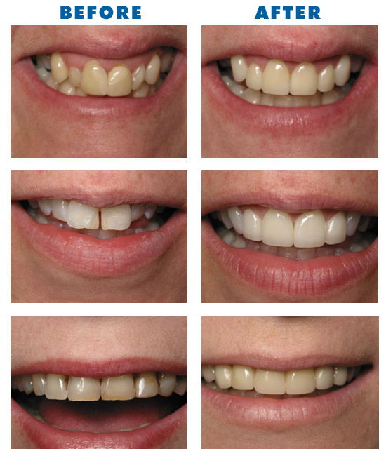 Explaining Fast Methods Of Veneers For Crooked Teeth | Our ...