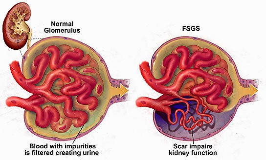 Focal Segmental Glomerulosclerosis Clinical Course And Outcome Of