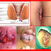 Obat herbal benjolan pada anus