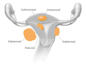 cara mengobati fibroid tanpa operasi
