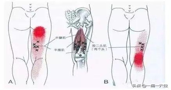 膝蓋後膕窩“筋短感”疼痛，每天堅持一個鍛煉方法，操作非常簡單(肌肉拉傷)