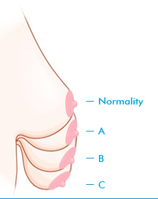 짱이뻐! - Korean Breast Plastic Surgery - Breast Lift 짱이뻐! - Korean Breast Plastic Surgery - Breast Lift