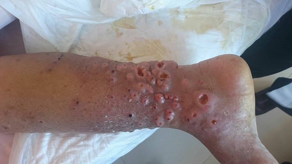 EL RINCÓN DE LA MEDICINA INTERNA: MICETOMA EL RINCÓN DE LA MEDICINA INTERNA: MICETOMA