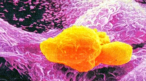 Με τι τρέφονται τα καρκινικά κύτταρα