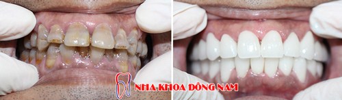 KHÔNG MÀI RĂNG CÓ BỌC SỨ ĐƯỢC KHÔNG -2