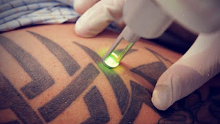 Permanent Tattoo Removal