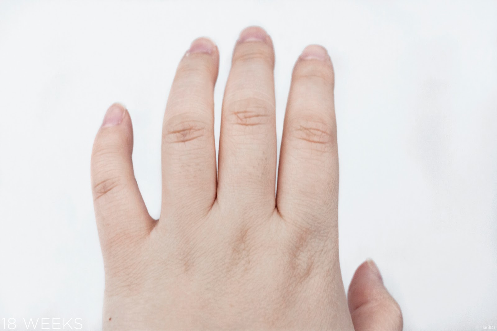 tria Hair Removal Laser Knuckle Hair 18 Weeks, 4 months