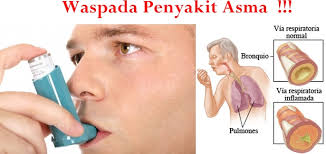 https://3.bp.blogspot.com/-_ZjYYWPStsw/WOcwTTmWMYI/AAAAAAAAAJo/LwZoxfK3XNEQK9Q4Nm6UWK37e_tmWG77wCLcB/s1600/asma%2B2.jpg