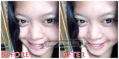 Cara Menghilangkan Jerawat Menggunakan Photoshop Cara Menghilangkan Jerawat Menggunakan Photoshop