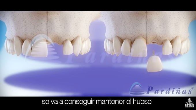 COMPARATIVA: Implante Dental vs Puente Fijo