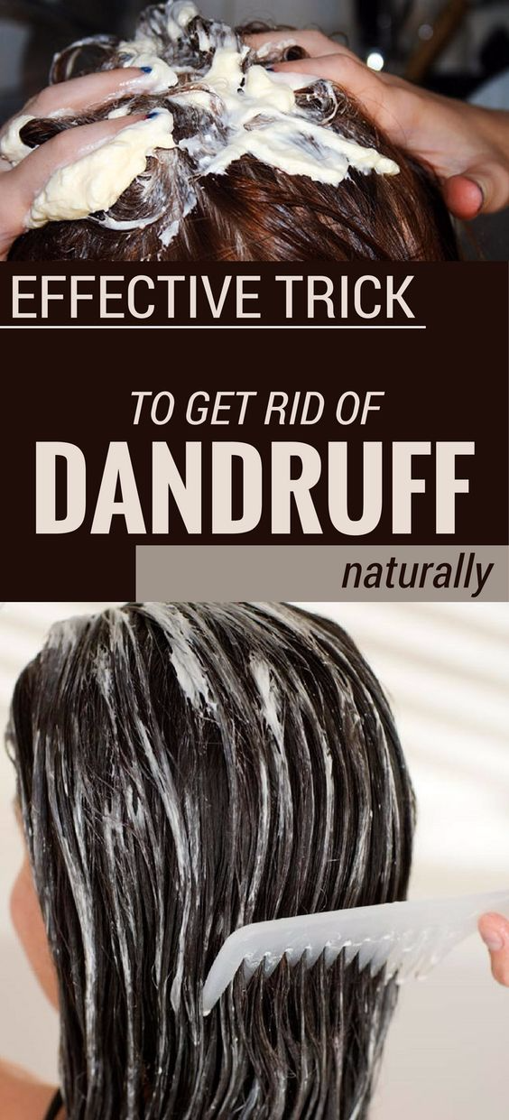 EFFECTIVE TRICK TO GET RID OF DANDRUFF NATURALLY HEALTHYLIFE