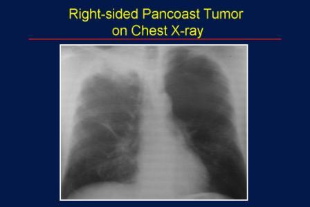 pancoast tumor medical and health information pancoast tumor
