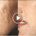 Make Your Facial Scars Disappear Using These Effective Home Remedies