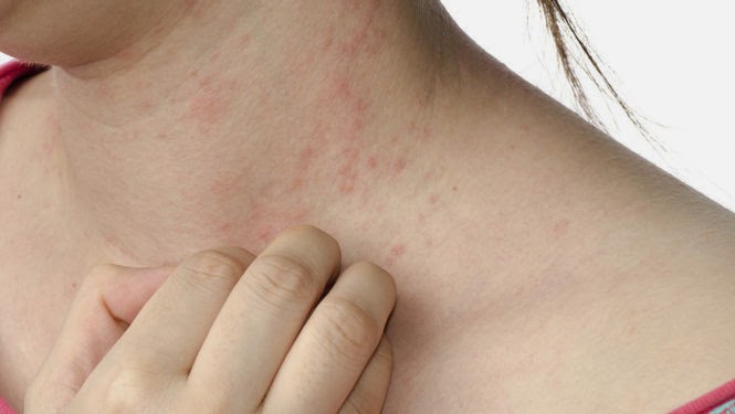 Psoriasis en la piel