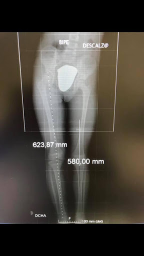 “Acho que Tenho uma Perna mais Curta que a Outra. Devo Compensá-la?”