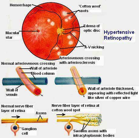 Angioma retinalne hipertenzije