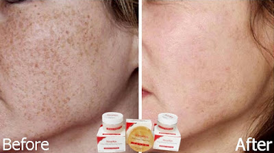 Cream Penghilang Flek Hitam Akibat Genetik/Keturunan Liyoskin Cream Penghilang Flek Hitam Akibat Genetik/Keturunan