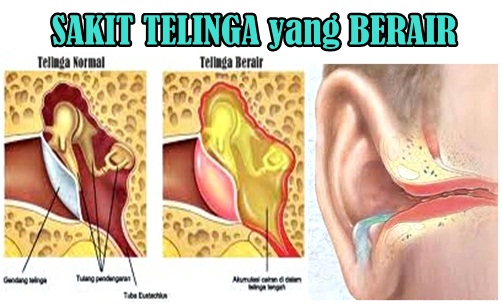 Atasi Telinga Berair dengan 6 Obat Tradisional Berikut