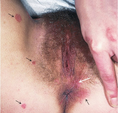 Psoriasis, with several psoriatic plaques