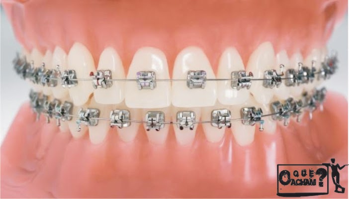 Aparelho dental