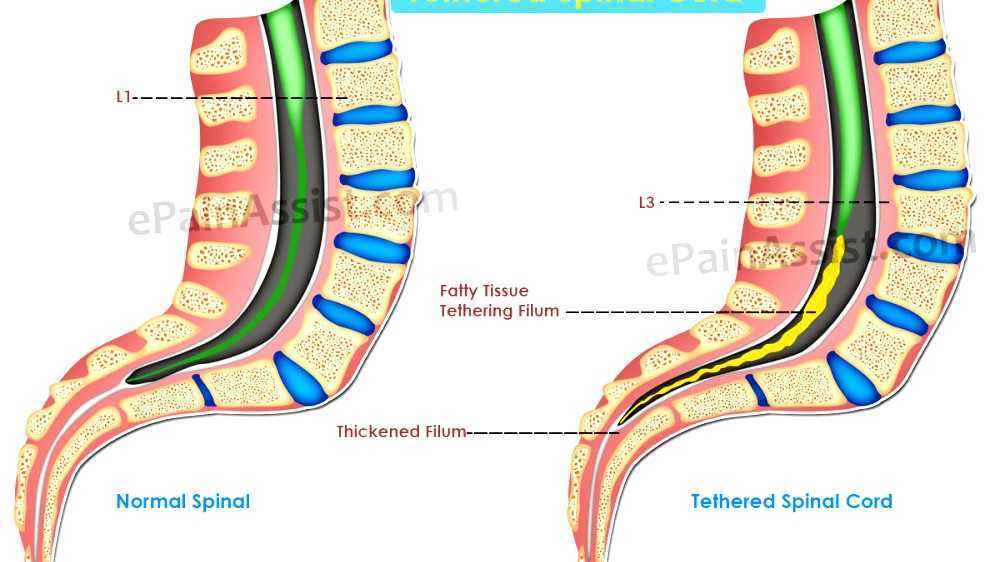 Tethered spinal cord syndrome